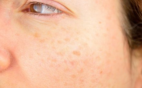 5 nguyên nhân phổ biến gây đốm nâu trên da ít ai biết để tránh