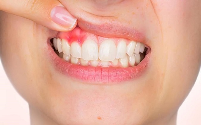 Top 10 nguyên nhân chảy máu chân răng ai cũng có thể gặp phải