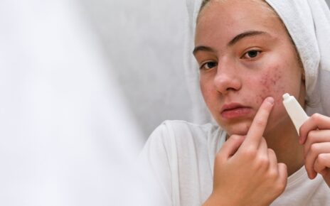 8 cách trị sẹo mụn tại nhà và những lưu ý để tránh sẹo do mụn